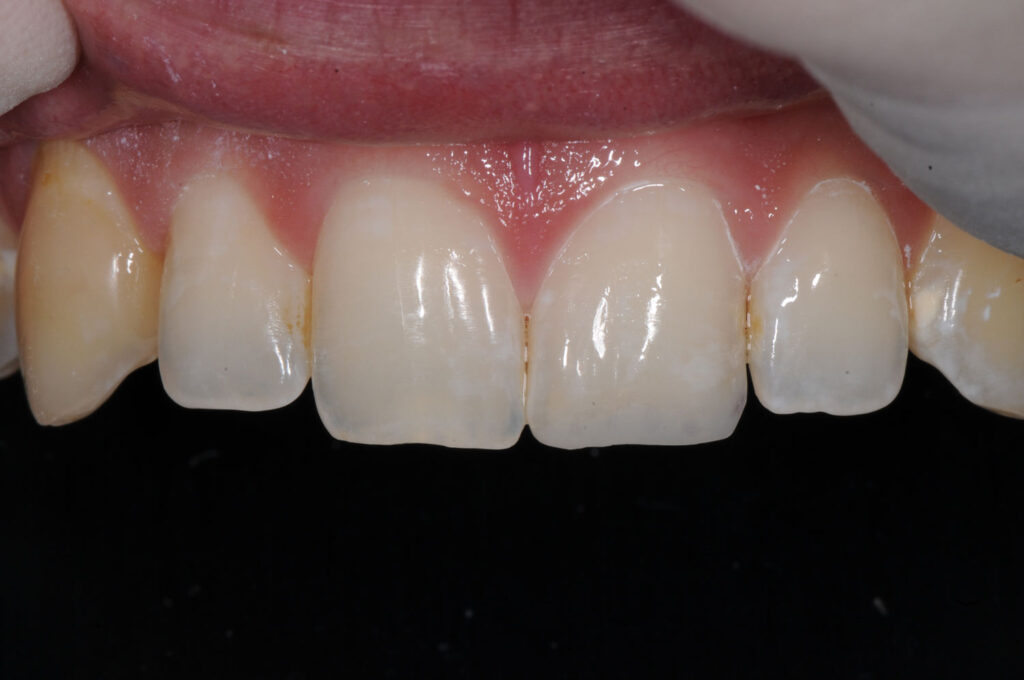 front teeth crowns